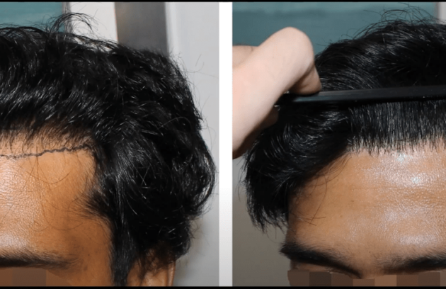 Hair Transplant Repair